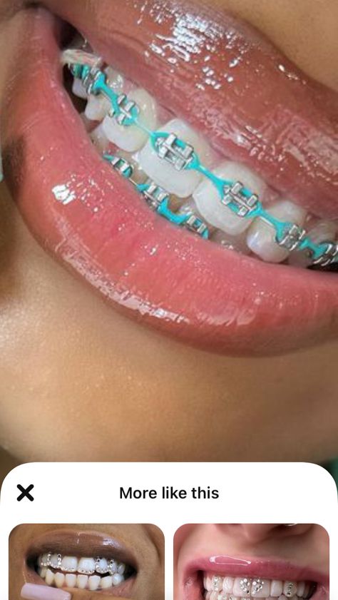 Cute Color For Braces, Teal Braces For Teeth, Teal Braces Aesthetic, Braces Sky Blue, Braces Light Blue, Bright Braces Colors, Blue Braces Aesthetic, Braces Rubber Bands Colors, Teal Power Chain Braces