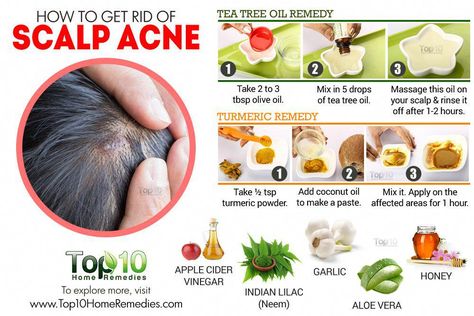 Pimples On Scalp, Severe Acne Remedies, Scalp Acne, Treat Acne Naturally, Cystic Acne Remedies, Painful Acne, Chest Acne, Forehead Acne, Back Acne