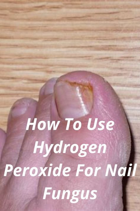 Body Infection, Fungal Infection Remedies, Infected Toenail, Toenail Fungal Infection, Nail Remedies, Toenail Fungus Remedies, Types Of Fungi, Nail Problems, Nail Infection