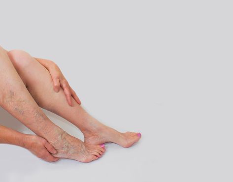 7 Tips For Managing Leg Leaking Water | Center for Vascular Medicine Skincare Moodboard, Pelvic Congestion Syndrome, Varicose Veins Causes, Varicose Vein Removal, House Spa, Leg Veins, Vein Removal, Cypress Oil, Venous Insufficiency