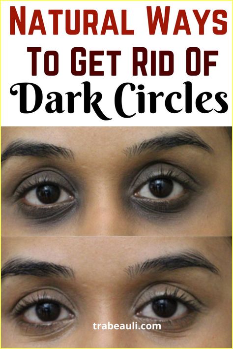 Dark Rings Under Eyes, Darkcircles Skincare, Dark Spots Under Eyes, Dark Circle Remedies, Dark Circles Around Eyes, Hooded Eyelids, Dark Eye Circles, Remove Dark Circles, Dark Circles Under Eyes