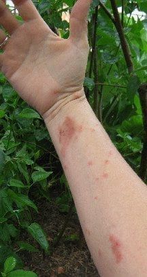 Poison Oak/Poison Ivy Rash: Contact Dermatitis | The Practical Herbalist Essential Oils For Poison Oak, Poison Sumac Remedies, Poison Oak Rash Pictures, Poison Oak Remedy, Poison Ivy Rash Pictures, Poison Sumac Rash, Oils For Poison Ivy, Poison Oak Rash, Poison Ivy Pictures