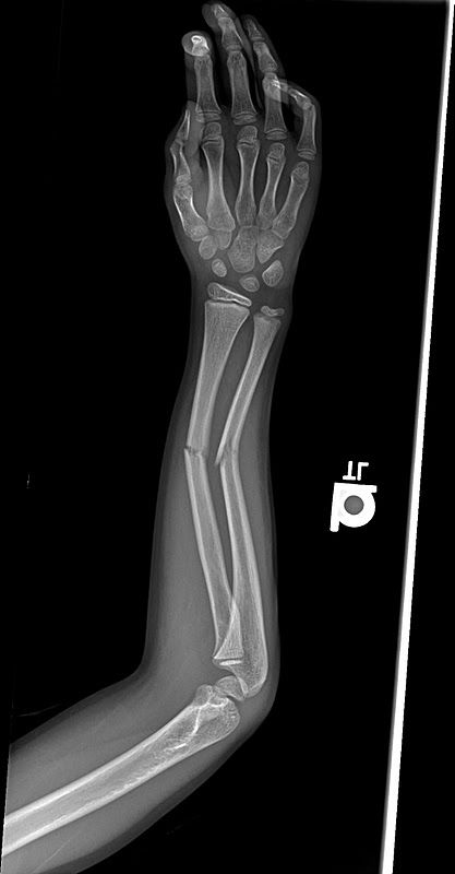 X-rays of Broken Bones | The above x-rays are before the bones were set and the ones below were ... Pictures Of Plants, Arm Bones, Ap Drawing, Bone Fracture, Broken Arm, X Rays, Orthopedic Surgery, Broken Leg, Guided Writing