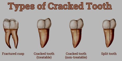 Cracked Tooth Syndrome | Lorne Park Dental | Mississauga Dentist Fca Ideas, Tooth Nerve, Cracked Tooth, Tooth Filling, Molar Tooth, Dental Fillings, Front Teeth, Dental Veneers, Tooth Enamel