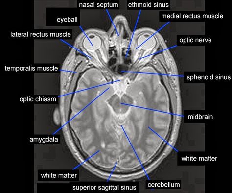 MRI temporalis muscle anatomy | Radiology Anatomy Images Mri Study Guide, Temporalis Muscle, Radiology Anatomy, Mri Anatomy, Brain Mri, Medical Radiography, Radiology Humor, Mri Tech, Mri Brain