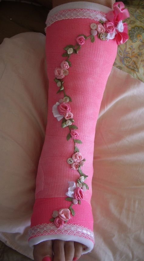 decorated cast - Google Search Cast Decoration, Kids Cast, Arm Cast, Cast Covers, Broken Foot, Ankle Surgery, Broken Ankle, Leg Cast, Cast Art