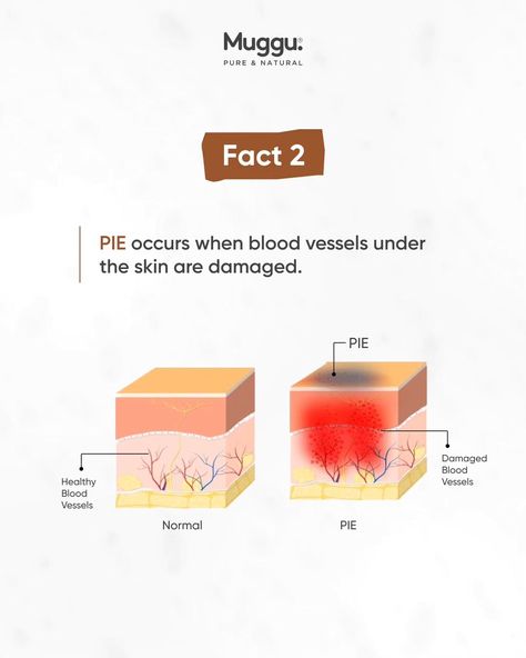 Think PIE is just a fancy name for dark spots? Think again! ⬅️Swipe through to uncover the truth about Post-Inflammatory Erythema (PIE): 1️⃣ PIE vs. Hyperpigmentation: Unlike hyperpigmentation, which manifests as dark spots due to excess melanin, PIE is characterized by red, pink, or purple marks caused by damaged blood vessels. Hyperpigmentation can be treated with brightening agents, while PIE requires soothing and barrier-repairing products.✨ 2️⃣ What Causes PIE?: PIE is typically cause... Remedies For Hyperpigmentation, Hyperpigmentation Remedies, Pie Pie, Think Again, Blood Vessels, Dark Spots, The Truth, Natural Remedies, Pie