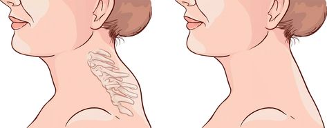 Cause of Buffalo Hump on Back of the Neck and Its Powerful Solution | Feel Good Life Buffalo Hump Causes, Buffalo Hump Before And After, Buffalo Neck Exercise, Lump On Back Of Neck, Buffalo Neck, Back Hump, Better Posture Exercises, Neck And Shoulder Exercises, Shoulder Posture