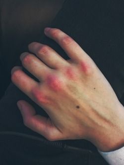 Injury Aesthetic, Knuckles Hand, Lost My Head, Blood Art, Hand Reference, Pretty Hands, Fan Fiction, Cat Wallpaper, Grunge Aesthetic