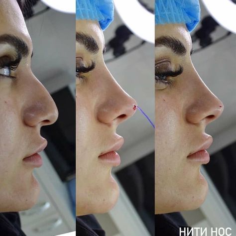 Refined Tip Rhinoplasty, Nose Thread Lift Before And After, Nose Filler Before After Non Surgical, Nose Inspiration, Liquid Rhinoplasty, Nose Plastic Surgery, Nonsurgical Nose Job, Nose Surgery Rhinoplasty, Beauty Job