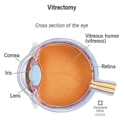 Vitrectomy: Definition, Details & Recovery Vitrectomy Surgery, Posterior Vitreous Detachment, General Anaesthesia, Gene Therapy, Vision Loss, Eye Surgery, Cleveland Clinic, Vital Signs, Scar Tissue