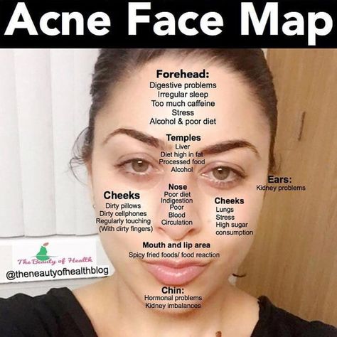 DrunkenLephant®️ on Instagram: “Did you know? ——— Follow @drunkenlephant for more!” Doterra Acne, Acne Face Map, Cheek Acne, Face Map, Lemon Mask, Face Mapping Acne, Bad Acne, Face Mapping, Acne Face