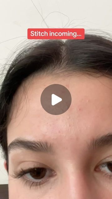 Matt Randon 🧩 on Instagram: "HOW TO GET RID OF BUMPS AND TEXTURE!😱 (follow for more!💗)  #acneproblems #acnetips #acnefree #blackhead #skincarecommunity #skincareaddict #skincareroutines #skincareobsessed #skincareproduct" Blackheads On Forehead, How To Get Rid Of Tiny Bumps On Forehead, How To Get Rid Of Bumps On Forehead, How To Get Rid Of Forehead Bumps, How To Get Rid Of Tiny Bumps On Face, Tiny Bumps On Forehead, Matt Randon, Forehead Bumps, Acne Free