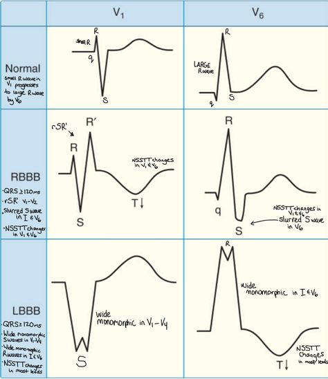 Bundle branch blocks ... Tall R wave ( RSR pattern, M shaped ) in Lead 1 & Slurred S wave in Lead V6 in RBBB ... Wide Notched R wave in LBBB ... 【 NSSTT - Non Specific ST-T wave abnormality 】 Left Bundle Branch Block, Bundle Branch Block, Cardiology Nursing, Paramedic School, Nursing Information, Cardiac Nursing, Critical Care Nursing, Nursing School Studying, Nursing School Notes