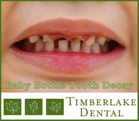 What is Baby Bottle Tooth Decay, and how does it happen?  Read this week's blog for answer.  https://www.timberlakedental.com/blog/2018/baby-bottle-tooth-decay-2/ Wisdom Teeth Quotes, Dental Office Organization, Wisdom Teeth Funny, Baby Bottle Tooth Decay, Dental Surgery Food, Teeth Illustration, Dentist Day, Black Teeth, Teeth Whitening Remedies