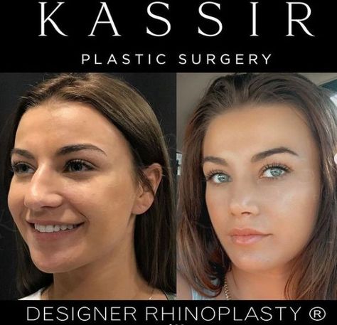 Nose Rhinoplasty, Nose Plastic Surgery, Rhinoplasty Nose Jobs, Rhinoplasty Before And After, Big Nose Beauty, Big Nose, Nose Job, Big Noses, Cosmetic Surgery