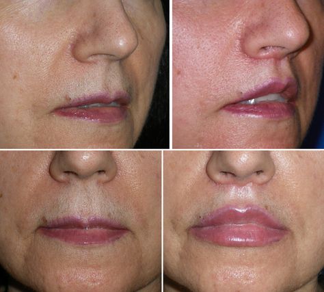 Lip Lift Richmond VA | Lip Implants | Injectable Fillers Lip Implants, Lip Outline, Lip Lift, Large Lips, Facial Surgery, Lip Augmentation, Injectables Fillers, Lip Enhancement, Lower Lip