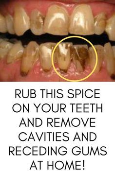 Reverse Cavities, Tooth Cavity, Tooth Decay Remedies, Remedies For Tooth Ache, Teeth Health, The Teeth, Oral Care Routine, Receding Gums, Gum Care