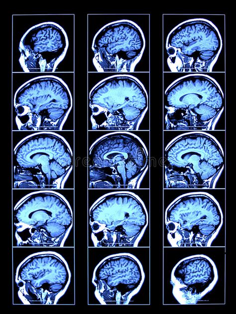 Ct Scan Brain, Ct Brain, Brain Pictures, Human Illustration, Brain Tattoo, Medical Words, Medical School Life, Motor Neuron, Post Grad Life