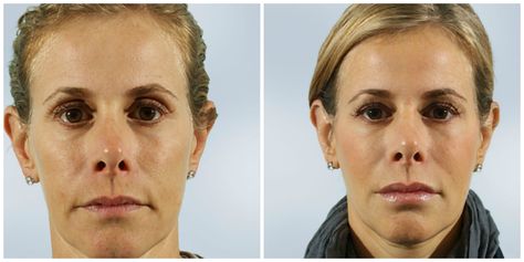 8 vials. After picture is at 5 months after first injections. Photos courtesy of Marina Peredo, MD #Sculptra Sculptra Aesthetic, Collagen Injections, Liquid Facelift, Facial Fillers, Skincare Treatments, Skincare 101, Facial Wrinkles, Nasolabial Folds, Natural Collagen