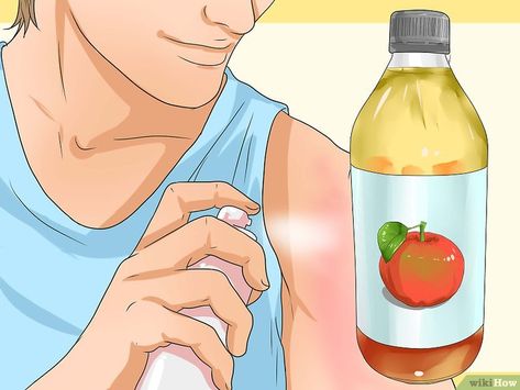 Sunburn Itch Relief, Heal Sunburn Fast, Sunburn On Face, Vinegar For Sunburn, Best For Sunburn, Sunburn Blisters, How To Help Sunburn, Home Remedies For Sunburn, Get Rid Of Sunburn