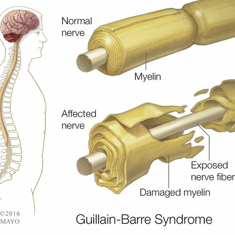 Multiple Sclerosis Symptoms, Guillain Barre, Guillain Barre Syndrome, Ms Symptoms, Rare Disorders, Nerve Fiber, Zika Virus, Multiple Sclerosis Awareness, Nerve Damage