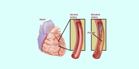 Angina Pectoris Nursing Care Plan Angina Pectoris, Nursing Care Plan, Medical Surgical Nursing, Lecture Notes, Practice Exam, Nursing Study, Nursing Notes, Lectures Notes, Nursing Care