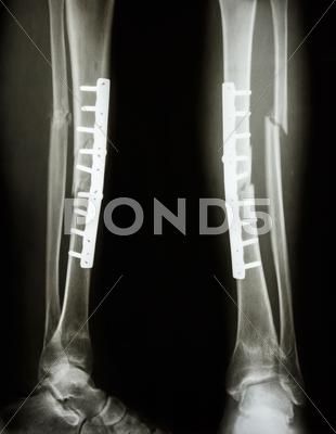 Fracture shaft of tibia and fibula Stock Photos #AD ,#tibia#shaft#Fracture#Photos Tibia And Fibula Fracture Recovery, Bone Fractures Types Of, Fracture Photo, Lefort Fracture, Trimalleolar Fracture, Anterior Talofibular Ligament Injury, Leg Bones, Business Card Template Design, Focal Length