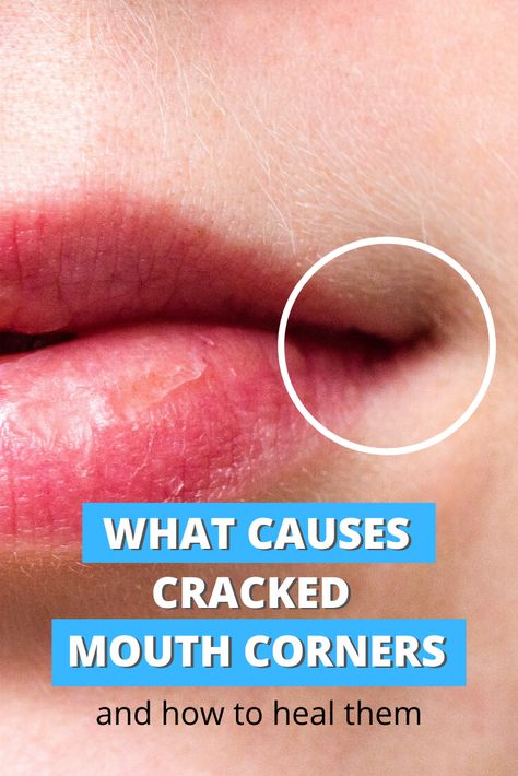 What causes cracked lip corners and how to heal them. Cracked Lip Corners, Cracked Corners Of Mouth, Cracked Fingertips, Angular Cheilitis, Abdominal Stretches, Dry Cracked Hands, Ways To Heal, Skin Bumps, Cracked Hands