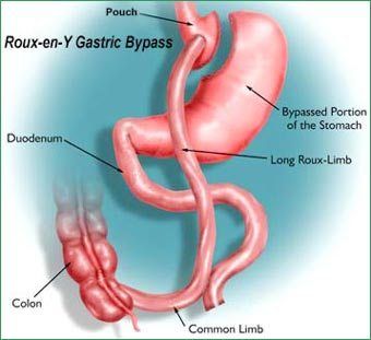 Gastric Bypass for those with a BMI of 25 while referring to this permanent major surgery as a "Band-Aid Procedure?"  Are you Kidding me?  http://dianekress.wordpress.com/2013/05/13/gastric-bypass-for-those-with-a-bmi-of-25-referring-to-major-surgery-as-a-band-aid-procedure-are-you-kidding-me/ Quick Fat Loss, Abdominal Surgery, Bypass Surgery, Juice Diet, Weight Problems, Fast Metabolism, Gastric Bypass, Junk Food, Cardio