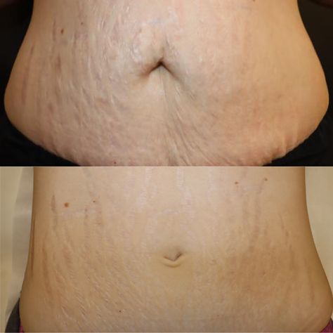 Before ➡️ After Treat stretch marks and scars with Morpheus8 BODY. 🙌 Morpheus8 treats the deeper scar tissue up to 8mm beneath the skin using radiofrequency energy with micro needling. This combination helps to reduce and minimize the stark appearance of stretch marks, and encourages new tissue growth that is aesthetically superior in texture, color and appearance 😍 Belly Strechmark, Morpheus8 Before And After, Morpheus 8 Before And After, Neck Pimples, Best Stretch Mark Removal, Morpheus 8, Stretch Mark Removal Cream, Strech Marks, Stretch Mark Remedies