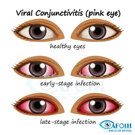 Conjunctivitis is a common eye problem and can be easily treated with a few simple precautions. Learn more about it at: http://afoptometry.com/Conjunctivitis.aspx  #Alabama #AFO #Optometry #AlabamaFamilyOptometry #Conjunctivitis Conjuctivita Eye, Eye Care Tips, Anniston Alabama, February Nails, Eye Exam, Healthy Eyes, Eyes Problems, Eye Doctor, Pink Eyes