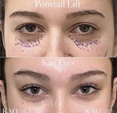 Eye Lift Surgery, Face Plastic Surgery, Easy Cat Eye, Cat Eye Tutorial, Face Fillers, Plastic Surgery Gone Wrong, Eye Tricks, Facial Fillers, Facial Contouring