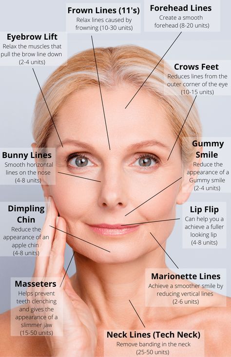 Botox Injection Sites, Facial Injections, Eyebrow Lift, Aesthetic Dermatology, Facial Anatomy, Botox Face, Facial Fillers, Cosmetic Injectables, Facial Plastic Surgery