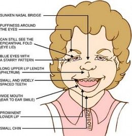 Willaims Syndrome is a rare but under diagnosed genetic disorder. This article explains the cause of this syndrome and the effects of the disease. It also explains some of the current research. #Pamela99, #WilliamsDisease, #genetic, #geneticdisorder Prader Willi Syndrome, Rare Genetic Disorders, Genetic Diseases, Slp Resources, Developmental Delays, Genetic Disorders, Ehlers Danlos Syndrome, Rare Disease, Pediatric Nursing