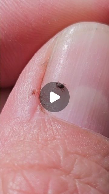 John on Instagram: "Tick Tips 🕷 #ticks #camping #outdoors #outdoorlife #selfreliance #reels #woodsman #survivaltips #hiking #campinglife #tickspray #tickprevention #tick #deerticks #survival" Tick Bites Pictures, Diy Tick Repellent, Homemade Tick Repellent, Get Rid Of Ticks, Tick Spray, Deer Ticks, Tick Bite, Tick Repellent, Tick Prevention