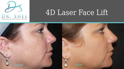 Are you interested in getting a Fotona 4D Laser Face lift? The team here at Dr. Shel Wellness & Aesthetic Center can help you out! Fotona 4d Laser Before After, Laser Face, Nurse Injector, Aesthetic Center, Wellness Aesthetic, Collagen Fibers, Nasolabial Folds, Wrinkle Reduction, Peeling Skin