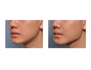 Jaw Angle, Facial Plastic, Plastic Surgery, Surgery, Facial, Beauty