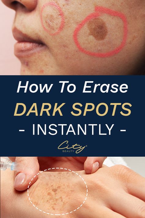 Here's a Great Solution Recommended by Beauty Experts to clear up dark spots, age spots & sun spots. How To Fade, Dark Spots On Face, Brown Spots Removal, Dark Spots On Skin, Skin Care Wrinkles, Spots On Face, Baking Soda Shampoo, Face Wrinkles, Remove Dark Spots