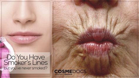 The following lines may appear on the lips: "smoker lines", "lipstick lines", "barcode lines", and "candy lines.". These vertical lines appear on the upper lip. Furthermore, these ageing lines become more prominent and deeper with age. You may also lose confidence due to these wrinkles around your mouth and lips. Lipstick lines are mainly annoying to women. Lipstick settles into these fissures and later bleeds into them. Ruining your entire appearance and making you feel less confident. Lip Line Filler, Lines Around Mouth, Upper Lip Wrinkles, Smokers Lines, Lip Wrinkles, Women Lipstick, Vertical Lines, Upper Lip, Dermal Fillers