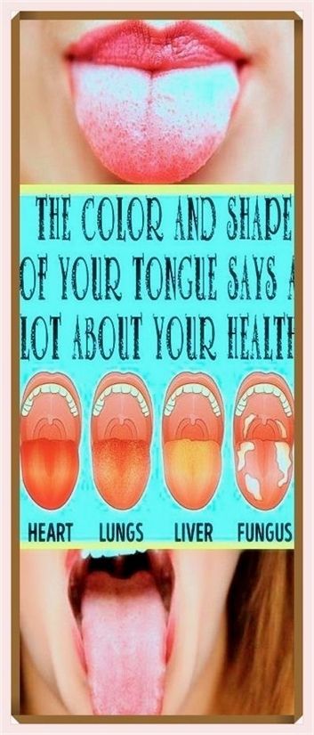 Let me know what I can do for you. Refreshing info! White Tongue, Canker Sore, Health Signs, Tongue Health, Heart And Lungs, The Tongue, Cold Sore, Nail Health, Traditional Chinese Medicine