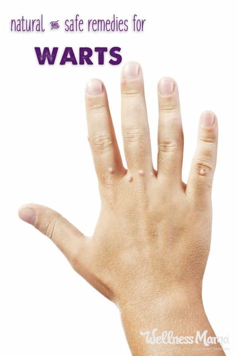 How to Get Rid of Warts Naturally (& What Causes Them) | Wellness Mama What Causes Warts, Natural Wart Remedies, Warts On Hands, Warts On Face, Home Remedies For Warts, Warts Remedy, Wellness Mama, Get Rid Of Warts, Home Remedy For Cough