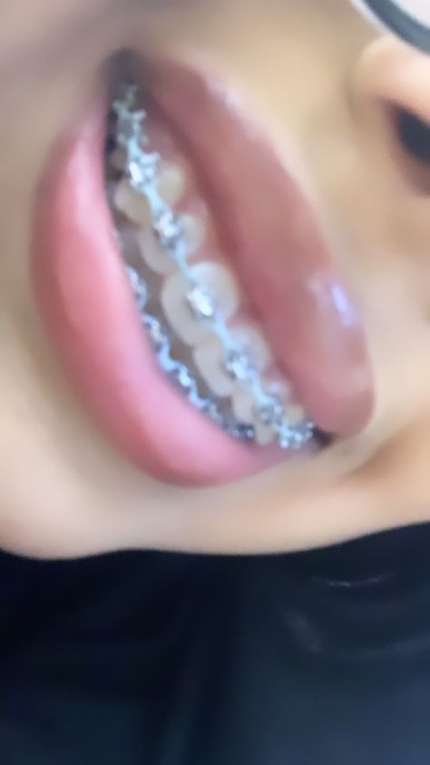 Light Blue Braces, Power Chain Braces, Dental Braces Colors, Pink Braces, Cute Braces Colors, Pretty Teeth, Braces Tips, Getting Braces, Health Aesthetic