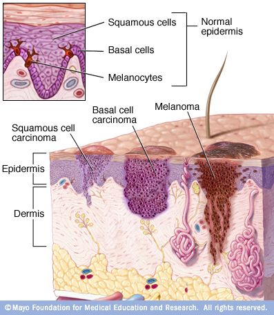 Skin Symptoms, Skin Anatomy, Basal Cell, Squamous Cell, Glow Skin, Skin Disorders, Medical Knowledge, Mayo Clinic, Medical Illustration