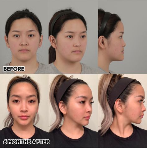 Orthognathic double jaw surgery and natural V line – IDHOSPITAL V Shaped Jaw, Square Jaw Reduction, Jawline Surgery, Jaw Line Exercise, Korean Nose Job, Jaw Reduction Surgery Before After, Double Jaw Surgery Before And After, Korean Nose, Jaw Surgery Before And After Overbite