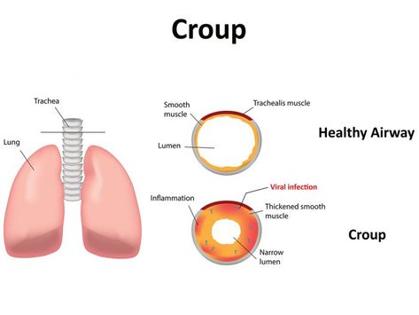 Top 11 Essential Oils for Croup Cough | Organic Facts Croup Essential Oils, Essential Oil For Bronchitis, Natural Medicine Recipes, Oil For Cough, Baby Cough, Essential Oils For Cough, Home Remedies For Bronchitis, Kids Cough, Essential Oils For Babies