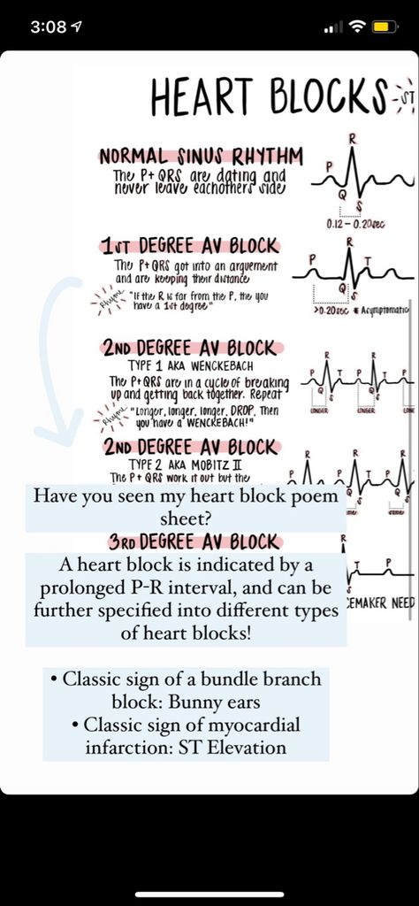 Sinus Rhythm, Normal Sinus Rhythm, Nursing School Motivation, Heart Blocks, Medical Assistant, School Motivation, Paramedic, Nursing School, Critical Thinking