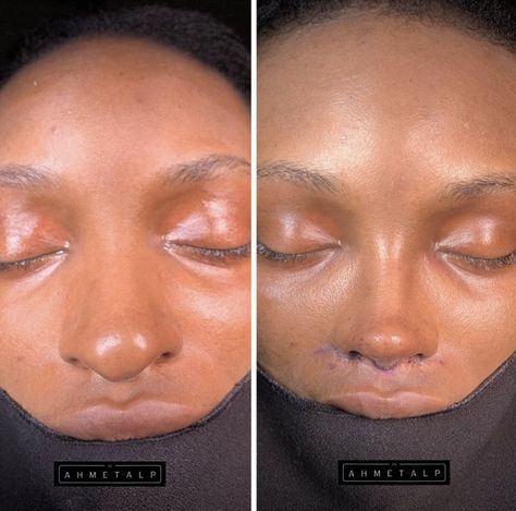 Rib Removal Surgery, Nose Job Transformation, Nose Jobs Black Women, Black Nose Job, Nose Surgery Before And After, Nose Job Black Women, Nose Job Before And After Black, Black Women Nose Job, Plastic Surgery Black Women