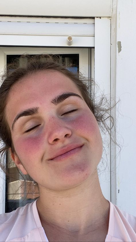 Sunburn Makeup Look, Sunburned Face, Cute Sunburn Face, Cute Sunburn, Sunburn Face, Sunburn Memes Humor, Summer 24, Reference Photos, Bucket List