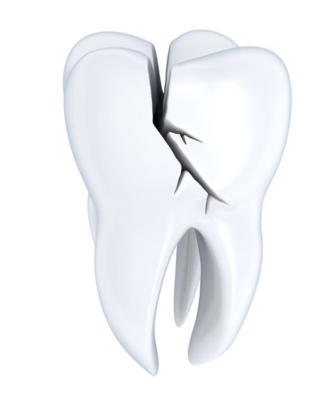 For a cracked tooth, immediately rinse the mouth with warm water to clean the area. Put cold compresses on the face to keep any swelling down. See your #dentist as soon as possible. Bad Hairline, Teeth Images, Cracked Tooth, Dental Emergency, Emergency Dentist, Pediatric Dentist, Tooth Extraction, Jaw Bone, Dental Problems